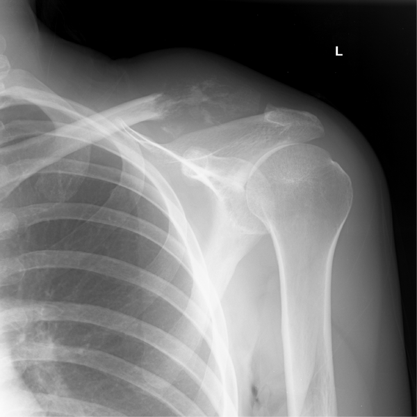 File:Breast cancer metastasis to distal clavicle - pathological fracture (Radiopaedia 12544-18239 Frontal 1).png