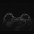 Breast implants - MRI (Radiopaedia 26864-27035 T2 SPAIR 15).jpg