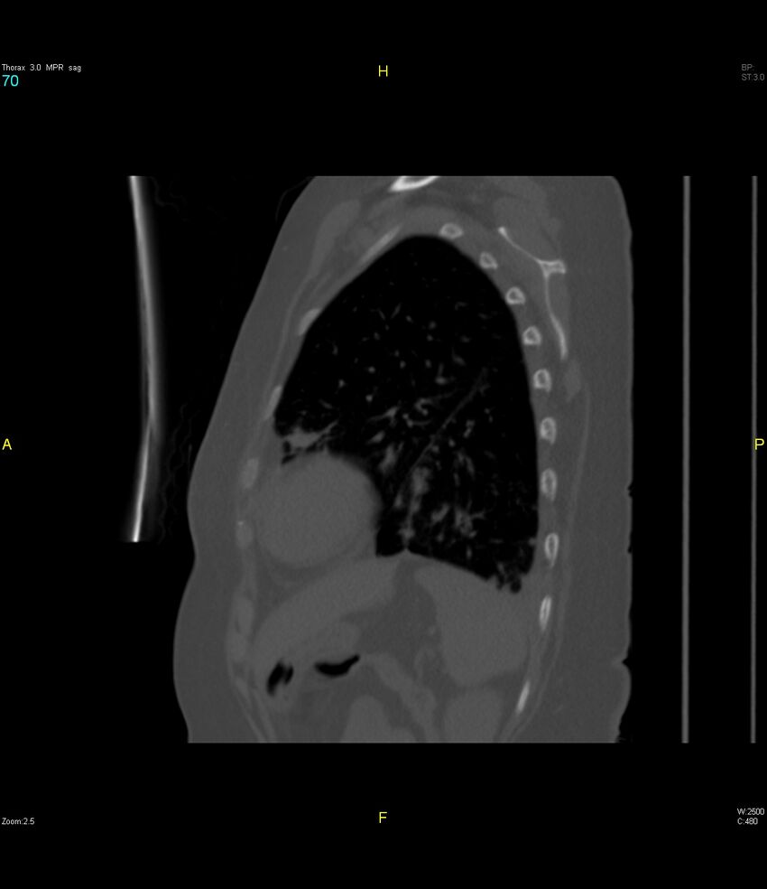 Breast primary with lung and bone metastases (Radiopaedia 40620-43228 Sagittal bone window 70).jpg