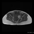 Broad ligament fibroid (Radiopaedia 49135-54241 Axial T1 10).jpg