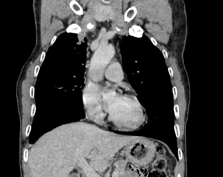 File:Bronchogenic carcinoma with superior vena cava syndrome (Radiopaedia 36497-38054 Coronal C+ delayed 13).jpg