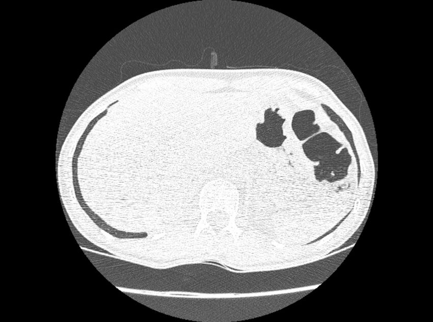 Bronchogenic cyst (Radiopaedia 80273-93615 Axial lung window 47).jpg