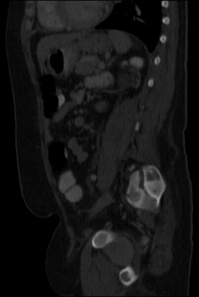 File:Brown tumors compressing the spinal cord (Radiopaedia 68442-77988 H 36).jpg