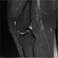 Bucket handle tear - lateral meniscus (Radiopaedia 7246-8187 Sagittal T2 fat sat 15).jpg