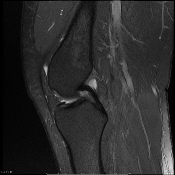 File:Bucket handle tear - lateral meniscus (Radiopaedia 7246-8187 Sagittal T2 fat sat 15).jpg
