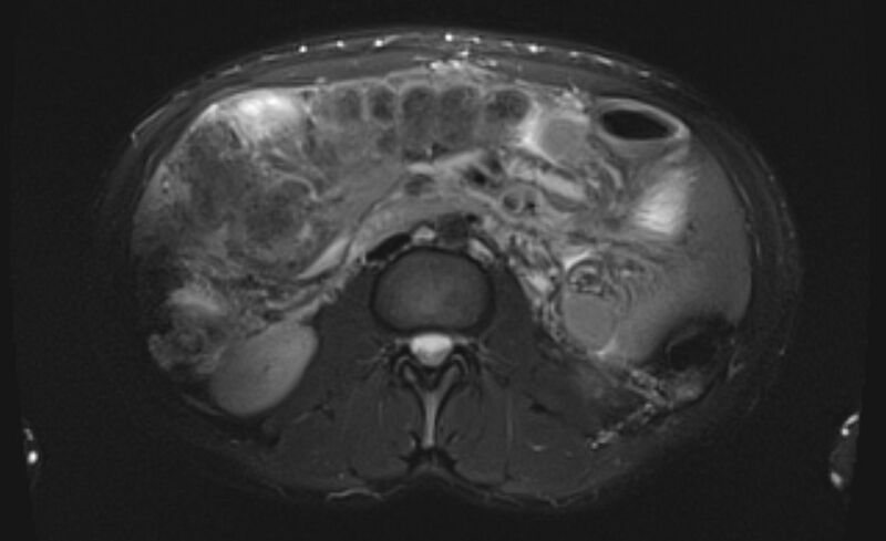 File:Budd Chiari syndrome (Radiopaedia 70299-80375 Axial T2 fat sat 30).jpg