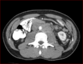Burned-out testicular choriocarcinoma (Radiopaedia 32822-34040 B 12).PNG