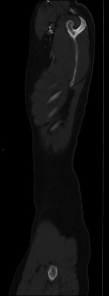 File:Burst fracture (Radiopaedia 83168-97542 Sagittal bone window 22).jpg