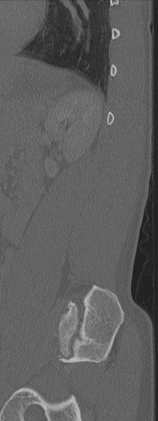 File:Burst fracture - T12 with conus compression (Radiopaedia 56825-63647 Sagittal bone window 11).png