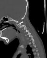 Butterfly vertebra (Radiopaedia 77903-90209 Sagittal bone window 17).jpg