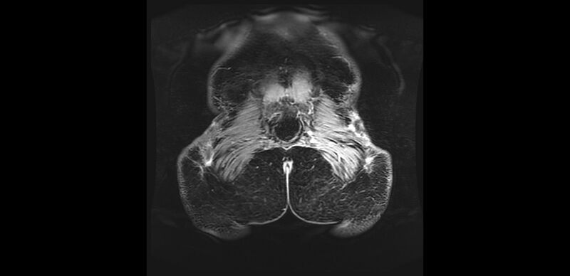 File:Buttock filler complications (Radiopaedia 63497-72115 Coronal T1 C+ 54).jpg