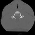 C5 facet fracture (Radiopaedia 58374-65499 Axial bone window 58).jpg