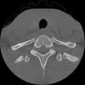 C5 facet fracture (Radiopaedia 58374-65499 Axial bone window 82).jpg