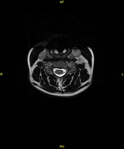 File:C5 nerve sheath tumor (Radiopaedia 85777-101596 Axial T2 29).jpg