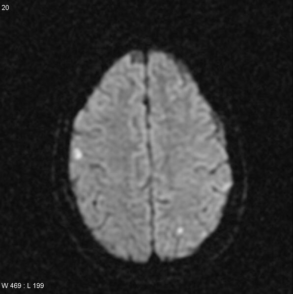 File:CMV ventriculitis and encephalitis (Radiopaedia 5416-7166 Axial DWI 8).jpg