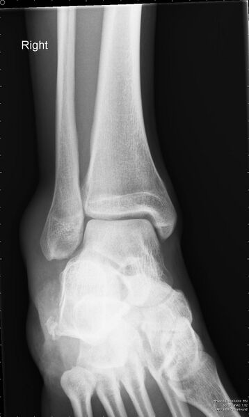 File:Calcaneal fracture (Radiopaedia 46201-50592 Frontal 1).jpg