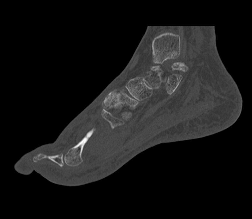 Calcaneal tuberosity avulsion fracture (Radiopaedia 22649-22668 Sagittal bone window 33).jpg