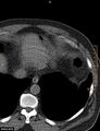 Calcified cardiac fibroma (Radiopaedia 39267-41519 Axial non-contrast 13).jpg