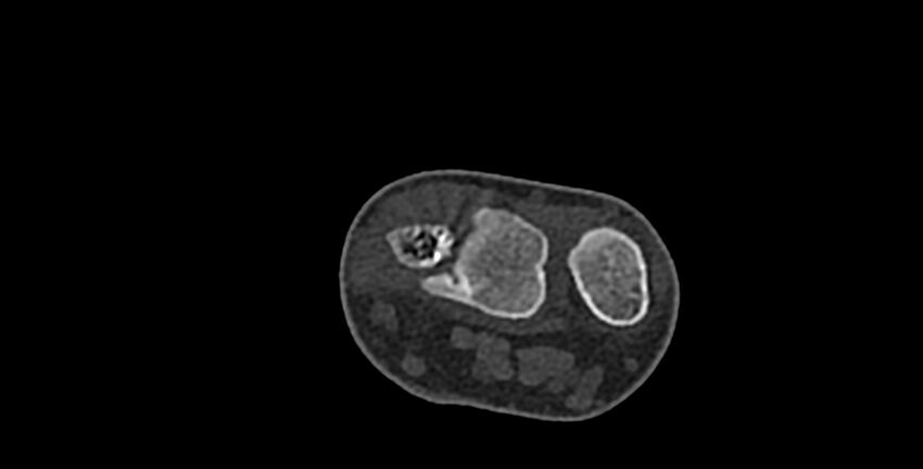Calcifying aponeurotic fibroma (Radiopaedia 88423-105064 Axial bone window 21).jpg