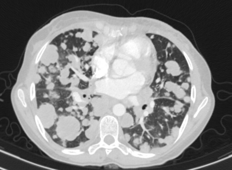 File:Cannonball metastases from breast cancer (Radiopaedia 91024-108569 Axial lung window 56).jpg