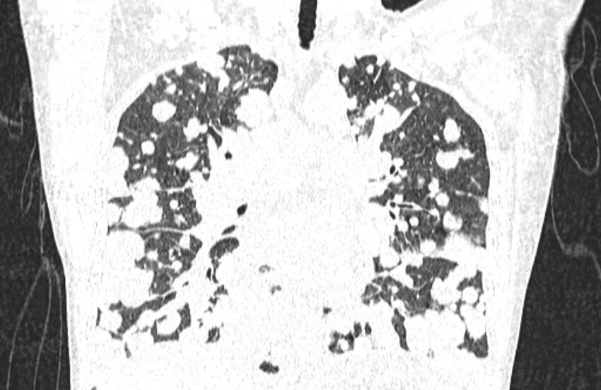 Cannonball metastases from breast cancer (Radiopaedia 91024-108569 Coronal lung window 74).jpg