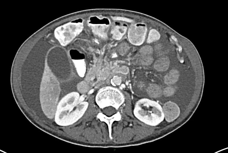 File:Carcinoid mesenteric tumor complicated by chylous ascites (Radiopaedia 76312-87953 A 31).jpg