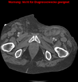 Cardiac perforation following transcatheter aortic valve implantation (Radiopaedia 23714-23863 B 14).png