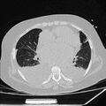 Cardiogenic pulmonary edema (Radiopaedia 29213-29609 Axial lung window 58).jpg
