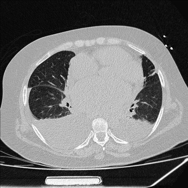 File:Cardiogenic pulmonary edema (Radiopaedia 29213-29609 Axial lung window 58).jpg