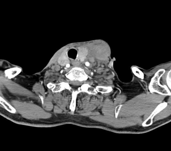 File:Carotid artery pseudoaneurysm (Radiopaedia 84030-99259 C 64).jpg