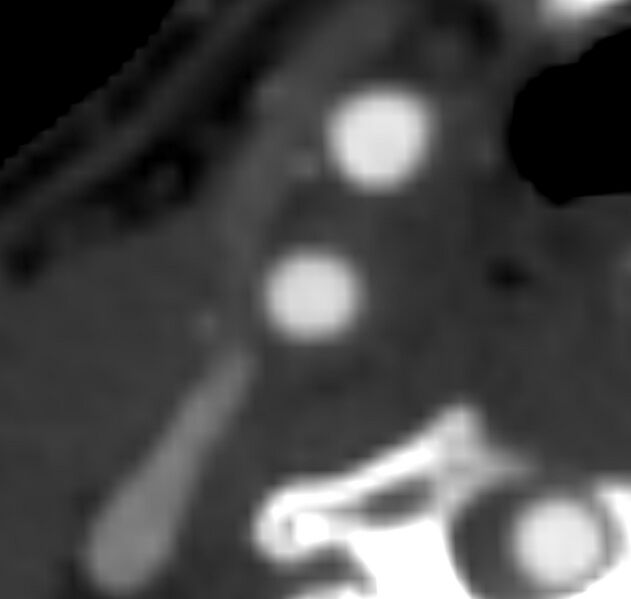 File:Carotid near-occlusion (Radiopaedia 85304-100887 M 59).jpg