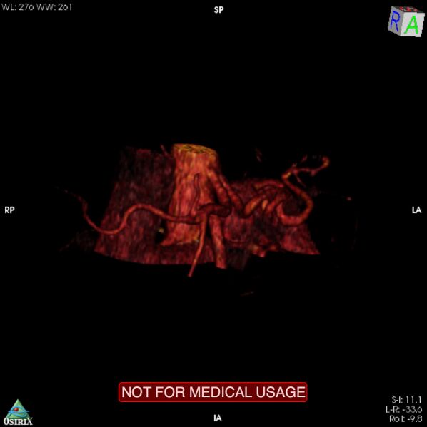 File:Celiac trunk variant anatomy - gastrohepatic trunk and splenic artery (Radiopaedia 38815-40995 B 1).jpg