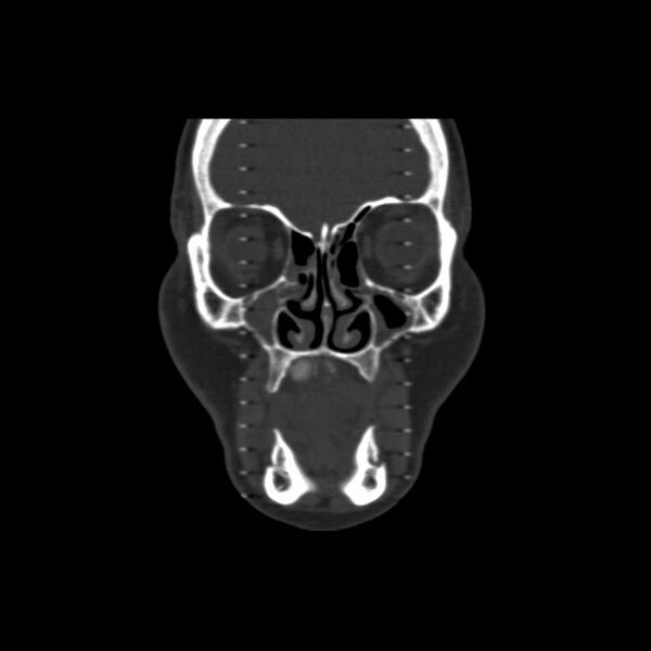 File:Cemento-ossifying fibroma (Radiopaedia 21243-21149 Coronal bone window 7).jpg