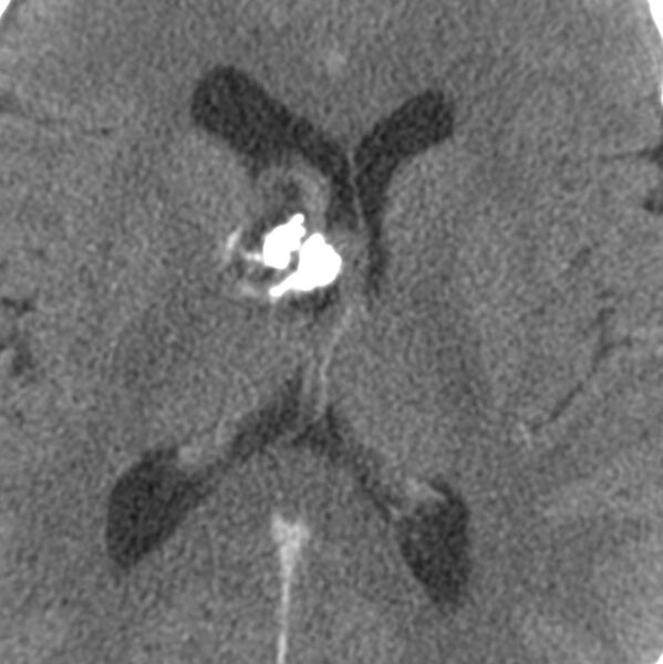 File:Central neurocytoma (Radiopaedia 68725-78432 C 17).jpg