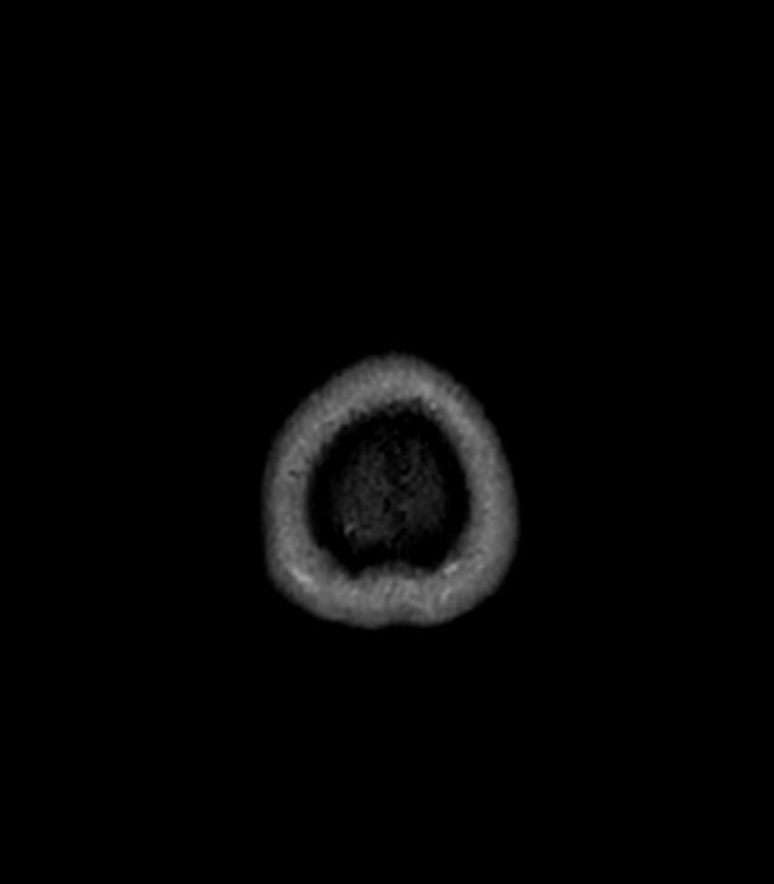 Central neurocytoma (Radiopaedia 79320-92380 Axial FLAIR 20).jpg
