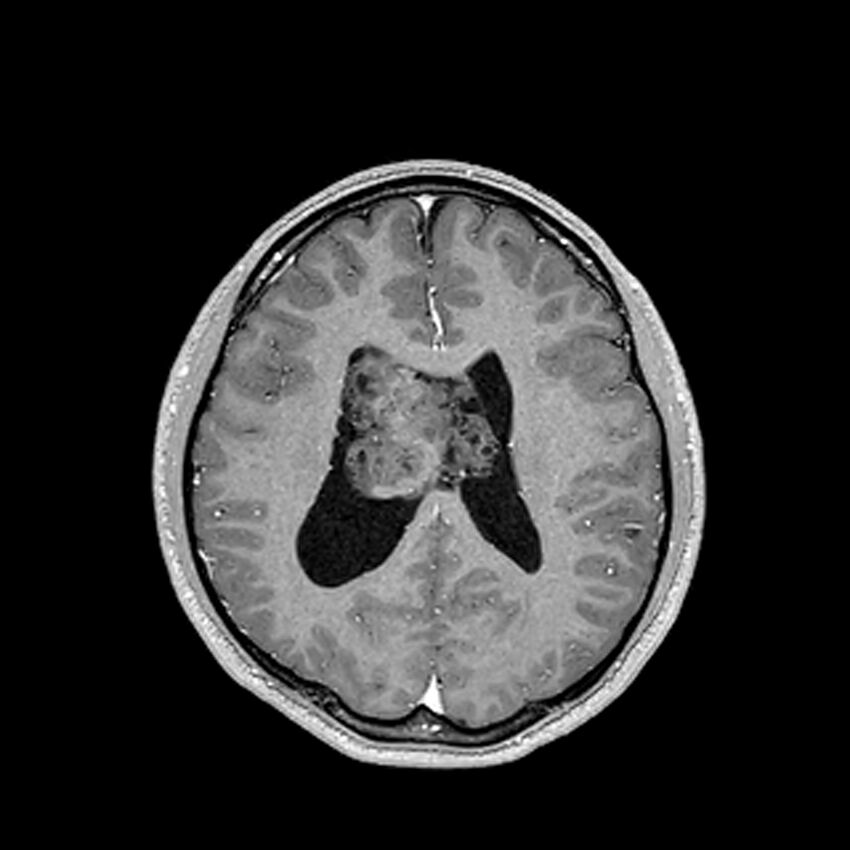 Central neurocytoma (Radiopaedia 79320-92380 Axial T1 C+ 155).jpg