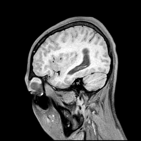 File:Central neurocytoma (Radiopaedia 79320-92380 Sagittal T1 196).jpg