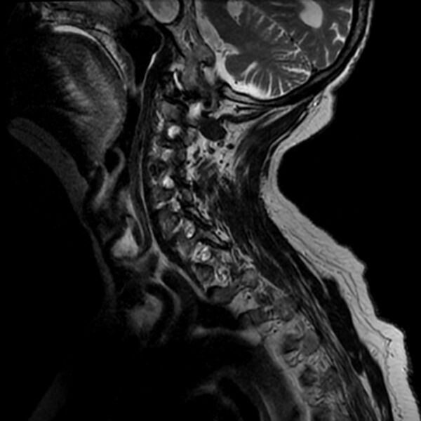 File:Cerebellar ataxia with neuropathy and vestibular areflexia syndrome (CANVAS) (Radiopaedia 74283-85159 Sagittal T2 9).jpg