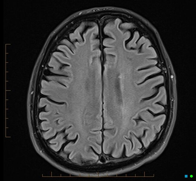 File:Cerebellar gangliocytoma (Radiopaedia 65377-74422 Axial FLAIR 27).jpg