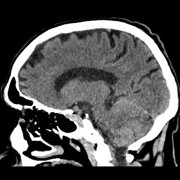 File:Cerebellar hemorrhage (Radiopaedia 27193-27359 C 19).jpg