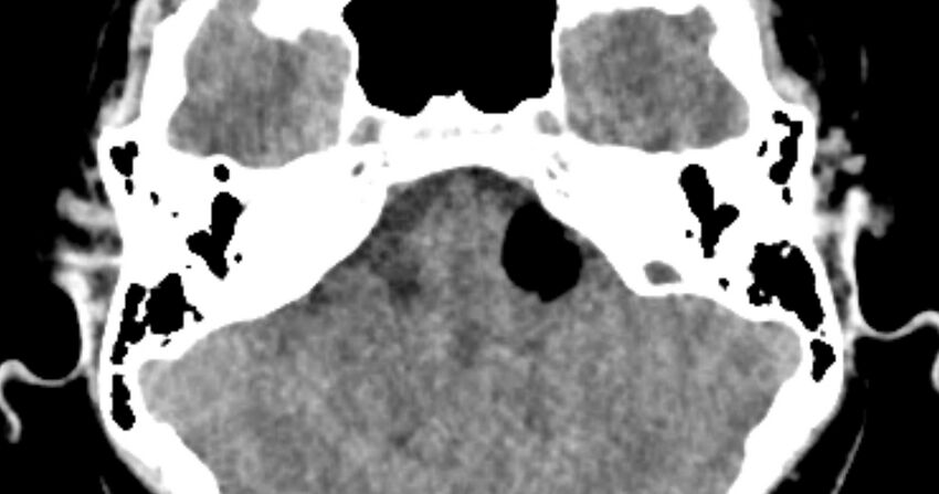 Cerebellopontine angle lipoma (Radiopaedia 57303-64242 B 29).jpg