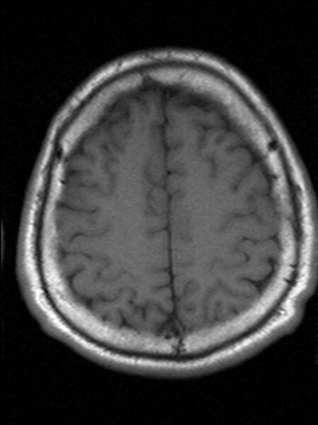 File:Cerebellopontine angle meningioma (Radiopaedia 24459-24764 Axial T1 19).jpg