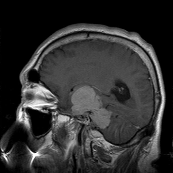 File:Cerebellopontine angle meningioma (Radiopaedia 24459-24764 Sagittal T1 C+ 8).jpg