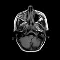 Cerebral abscess post cardiac surgery (Radiopaedia 27244-27420 Axial FLAIR 3).jpg