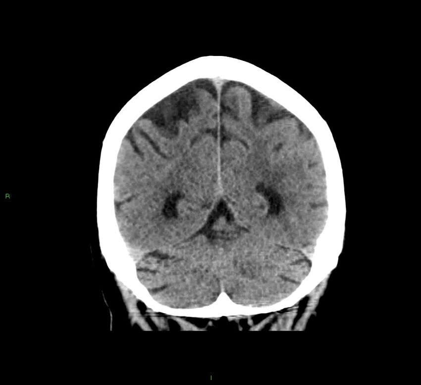 Cerebral amyloid angiopathy-associated lobar intracerebral hemorrhage (Radiopaedia 58376-65511 Coronal non-contrast 19).jpg