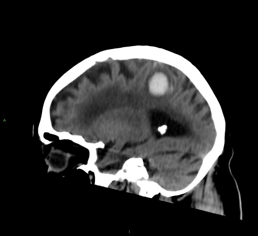 Cerebral amyloid angiopathy-associated lobar intracerebral hemorrhage (Radiopaedia 58376-65513 C 29).jpg