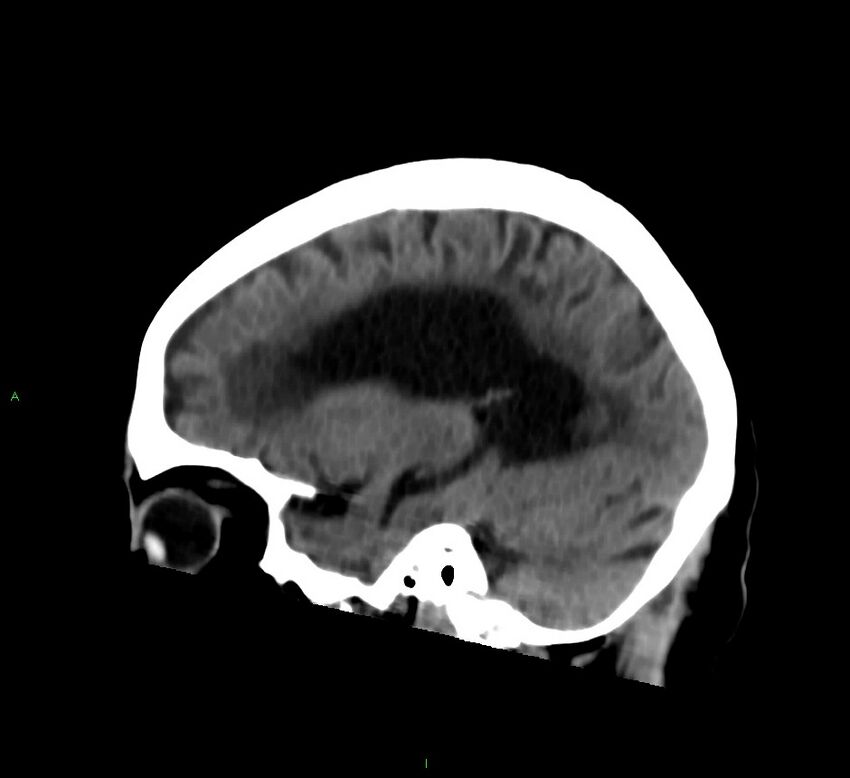 Cerebral amyloid angiopathy-associated lobar intracerebral hemorrhage (Radiopaedia 58376-65513 C 47).jpg