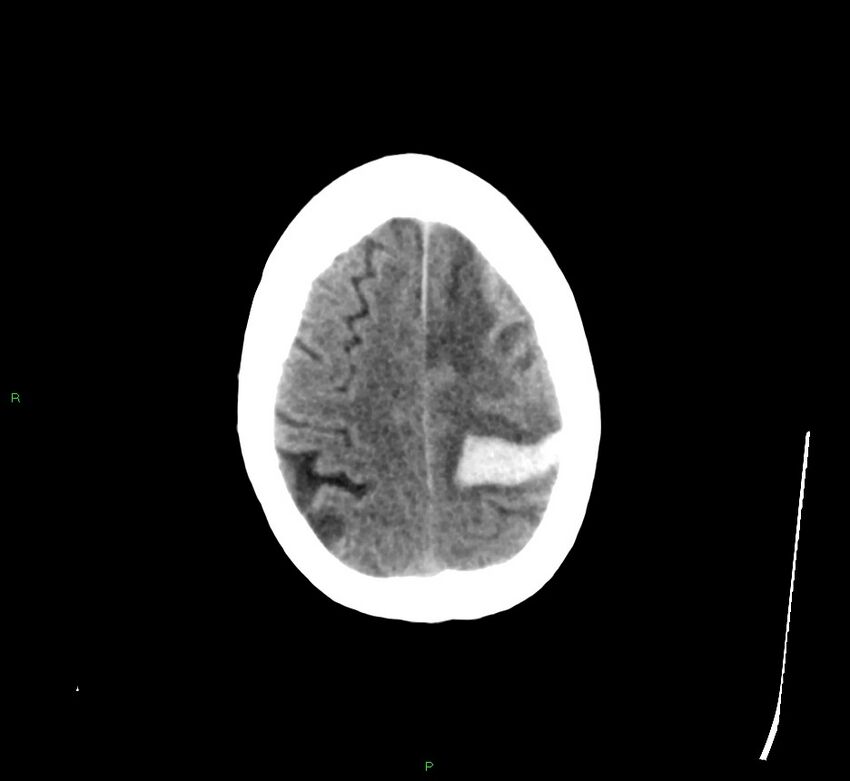 Cerebral amyloid angiopathy-associated lobar intracerebral hemorrhage (Radiopaedia 58529-65681 Axial non-contrast 10).jpg