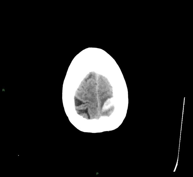 File:Cerebral amyloid angiopathy-associated lobar intracerebral hemorrhage (Radiopaedia 58529-65681 Axial non-contrast 6).jpg