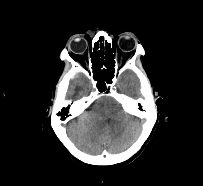 File:Cerebral amyloid angiopathy-associated lobar intracerebral hemorrhage (Radiopaedia 58751-65972 Axial non-contrast 37).jpg